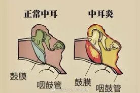 孩子耳朵疼、反复发热，可能是这种疾病在作怪图片