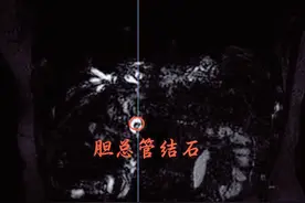胆囊切除十年后再次遭遇胆结石，医生提醒：切除胆囊“管不了”胆管图片