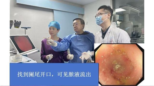 阑尾：我才不是可有可无的。市二医院内镜下解锁阑尾炎治疗新方案