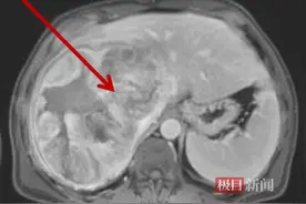 六旬老人暴瘦20斤，原来肝脏上长出“巨无霸”肿瘤，协和专家冒险“拆弹”图片