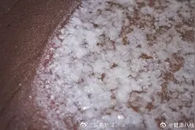 湿疹或与摄入盐分过量有关图片