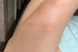 最近！身上突然不明原因痒一下、又红又肿，赶紧打开这篇！（不是蚊子）图片