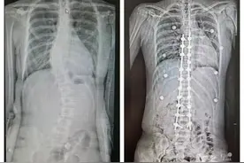 13岁女孩身高超1米7，确诊为罕见病！身体出现这个情况要当心图片