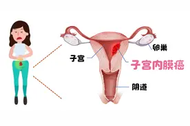 更年期这些“变化”，可能是被子宫内膜癌盯上了图片