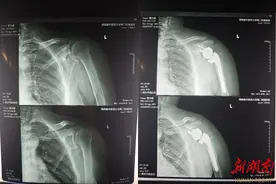 60多岁钓鱼“佬”钓出肩关节病？专家提醒：钓鱼养身养心，也要注意方式图片