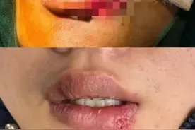 吓人！男子与爱宠“亲亲”，半个嘴唇被咬掉！图片