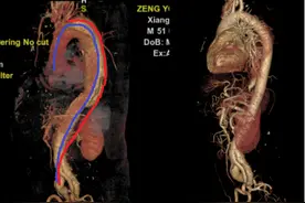 12小时 置换50厘米主动脉血管 湘雅团队成功救治胸腹主动脉瘤患者图片