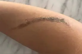 女子拍打毒隐翅虫后皮炎10天未愈，专家：不要拍打，它们不咬人图片