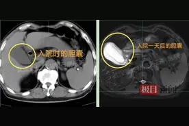 胆囊惊现“小堵王” 结石作祟肿成两个大，医生提醒：小结石大麻烦切勿轻视图片