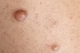 皮肤上消不掉的“硬疙瘩”，会癌变吗？图片