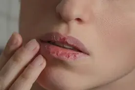 【健康】嘴唇总是干裂起皮，别光补水了！可能是身体这里出了问题图片