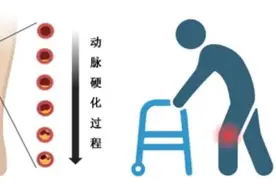 腿冷、发麻、走不远，原来是“腿梗”图片