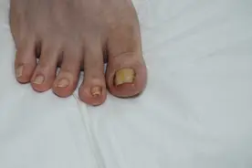 爱穿高跟鞋，她趾甲长进肉里，能彻底根治吗？图片