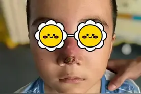 血泪教训！福建7岁男孩被紧急送医！竟是因挤了颗痘痘……很多人看完一阵后怕图片