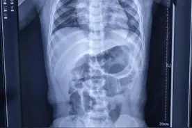 一岁幼童吞下金戒指，医生提示：家有幼儿，这些物件要收好图片