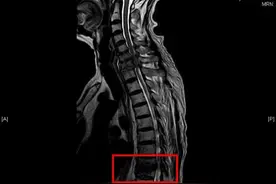 腰背疼痛不可一“贴”了之 警惕脊柱结核导致瘫痪图片