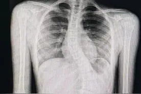 11岁女孩“坐没坐相”，竟是脊柱重度侧弯畸形图片