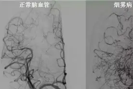 40岁男子患病后神志不清，“烟雾病”听说过吗？还不宜吃辣椒面条热汤图片