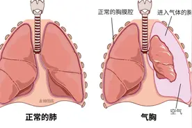 一口气做20个俯卧撑后，男子的肺“炸”了……咋回事？图片