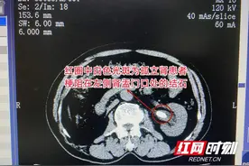 嗲嗲早年因结石切除右肾 如今左肾也陷入结石危机险患尿毒症图片