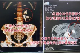 女子连续3天出现浓茶色血尿，就医才知结石引发重度积水险毁肾图片