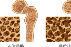 浙江女子突然变矮5厘米！竟是因为...图片