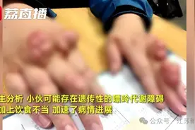 小伙双手长满“石头”，大如乒乓球！这些习惯千万注意……图片
