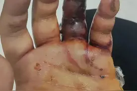 福建有人被咬伤！10月仍是蛇的活跃期，医生提醒图片