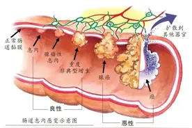 一家8口确诊同种病，一人患癌！医生：遗传性极强，若不干预35岁前很有可能……图片