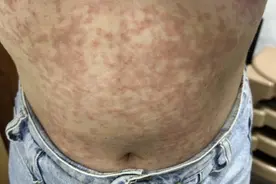 密密麻麻！最近接连有人中招！医生：赶紧停掉！图片