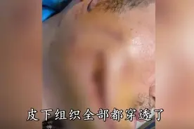 男子学狗语和爱犬沟通，凌晨紧急送医，脸被咬穿！医生提醒：这个动作很大风险！图片