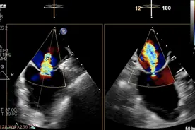 刷新纪录！华西心脏内科成功救治97岁高龄的二尖瓣反流患者！图片