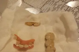 江苏一老人诊疗中6颗牙齿进入体内，去世时还有1颗在肺里，院方建议走第三方鉴定程序图片