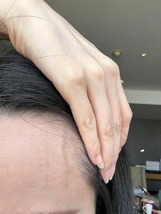 张靓颖自曝体检营养不良