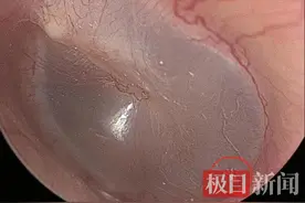 男子和猫同睡耳中长出猫螨虫:米粒大小正在鼓膜上爬行图片