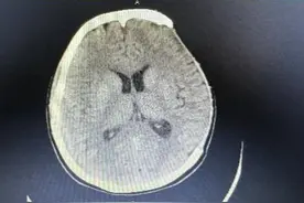 山东首例|枣庄市中医医院成功开展首例全PEEK系列颅骨修补术图片