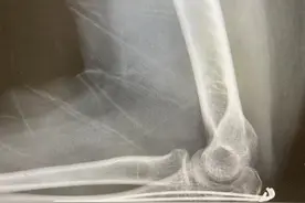 女子肘关节能屈不能伸，原因竟是术后忽略康复治疗图片