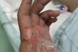 手指带伤切生猪肉，意外感染猪链球菌险些丧命图片