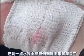 拎烧水壶玩“泼水成冰”？女子把自己烫得满脚大泡图片