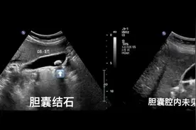健康小站丨胆囊结石上演神奇“消失术”，背后原因竟是……图片