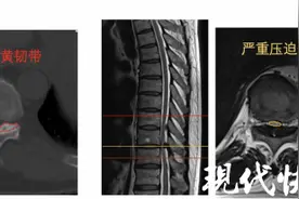 走路像踩棉花？除了颈腰椎还得查查这里图片