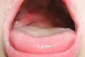 入秋换季，手足口病和疱疹性咽峡炎高发如何防范？图片