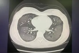 警示！防晒喷雾使用不当，1小时可致“白肺”，而且……图片