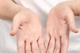 为什么一到换季，手就开始脱皮？图片