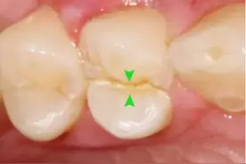 为什么做完根管治疗还要做冠呢？图片