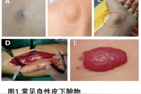 科普｜常见皮下肿物有哪些？图片
