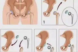 医生提醒：髋关节置换术后，应当注意这些事项→图片