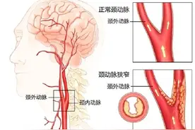 颈部血管彩超：预防脑血管疾病的“秘密武器”图片