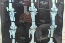 外卖骑手送餐摔倒致残：劳务公司被判赔十万余元后上诉，平台获判无责图片