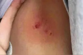 黔灵山公园猕猴咬伤游客背部，公园：已消毒处理，狂犬疫苗费用可报销图片